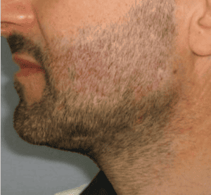 Beard-Transplant-After