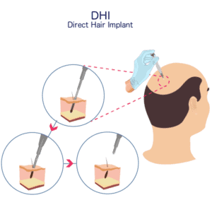 DHI-Hair-Transplant-Procedure-min