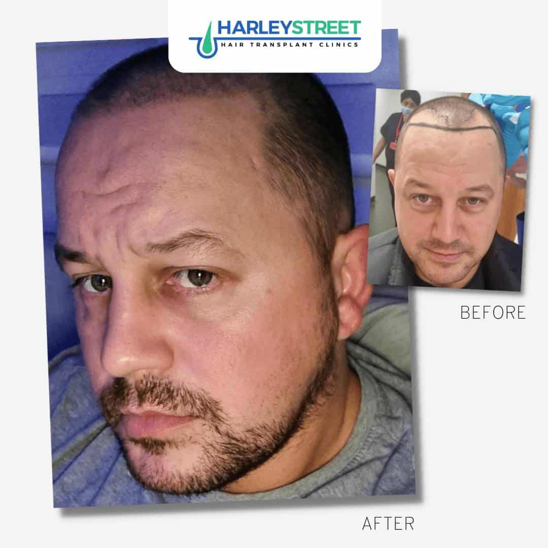 Hair Transplant Glasgow FUE Hair Transplant Experts HIS Clinics