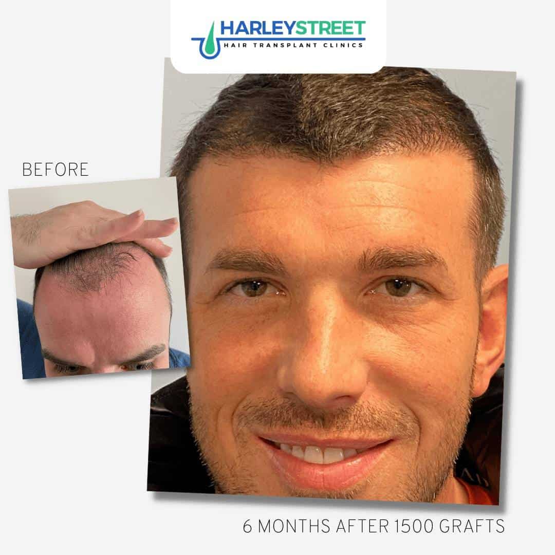 Hair Transplant Glasgow FUE Hair Transplant Experts HIS Clinics