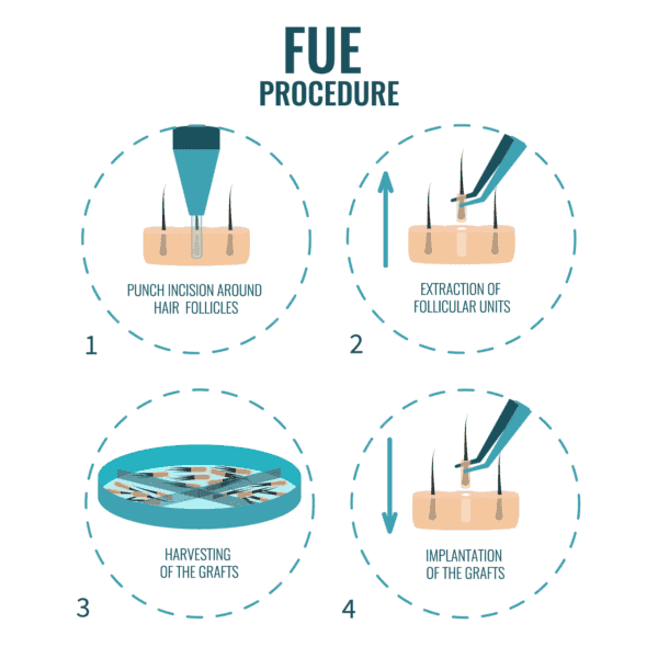 FUE-Hair-Transplant-Procedure