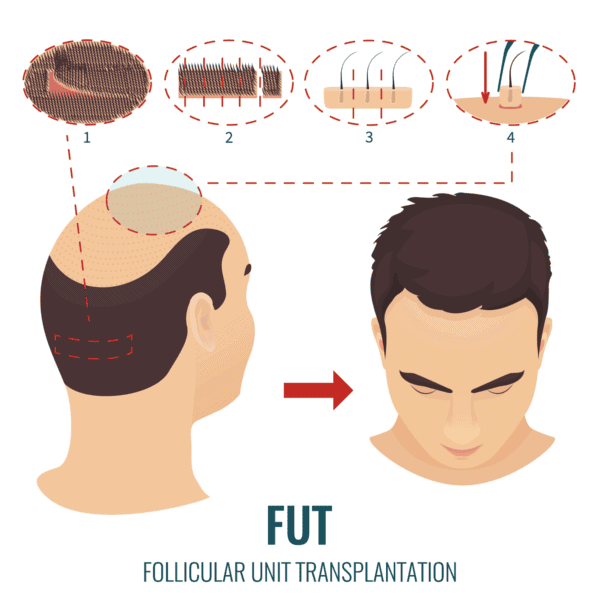 FUT-Hair-Transplant-Procedure-min