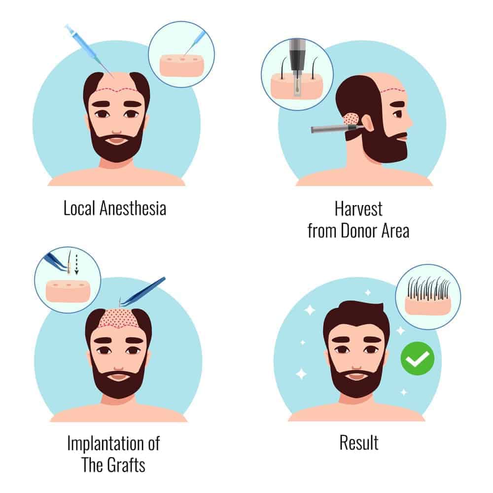 Hair-Transplant-Procedure-and-process-min