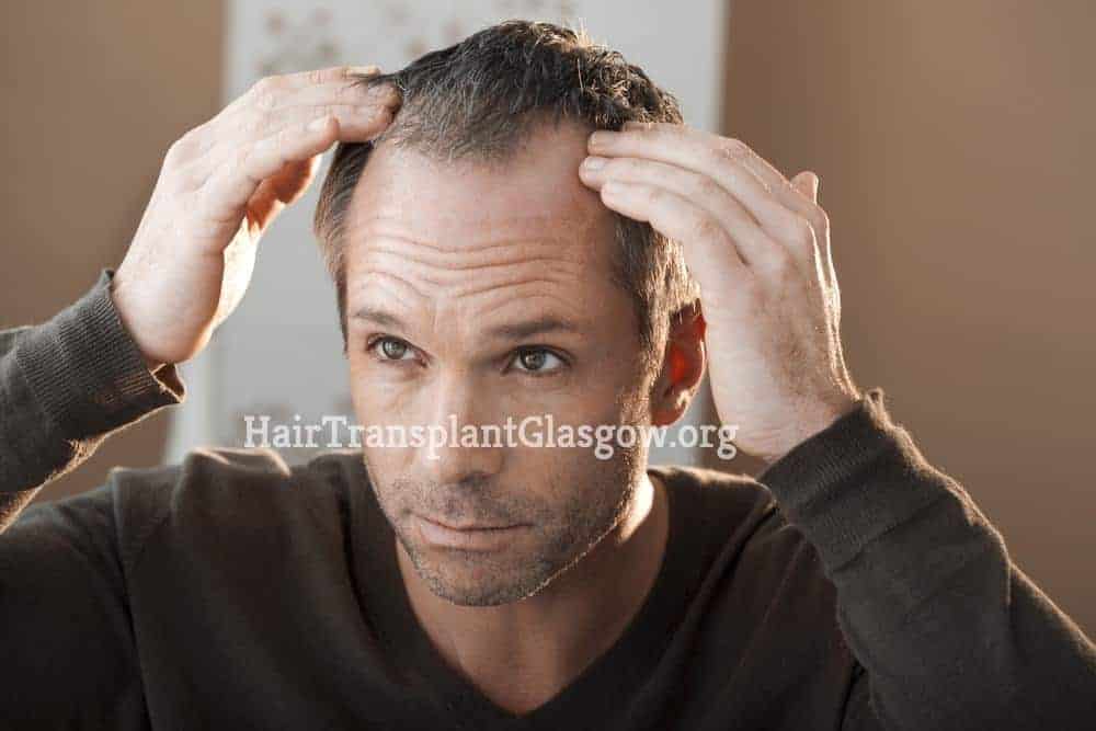 Hair loss in men image-min