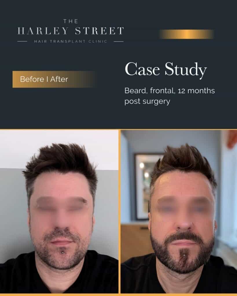Beard Transplant 2 Harley-Street-HT-Patient-Beard-P-Burley-frontal