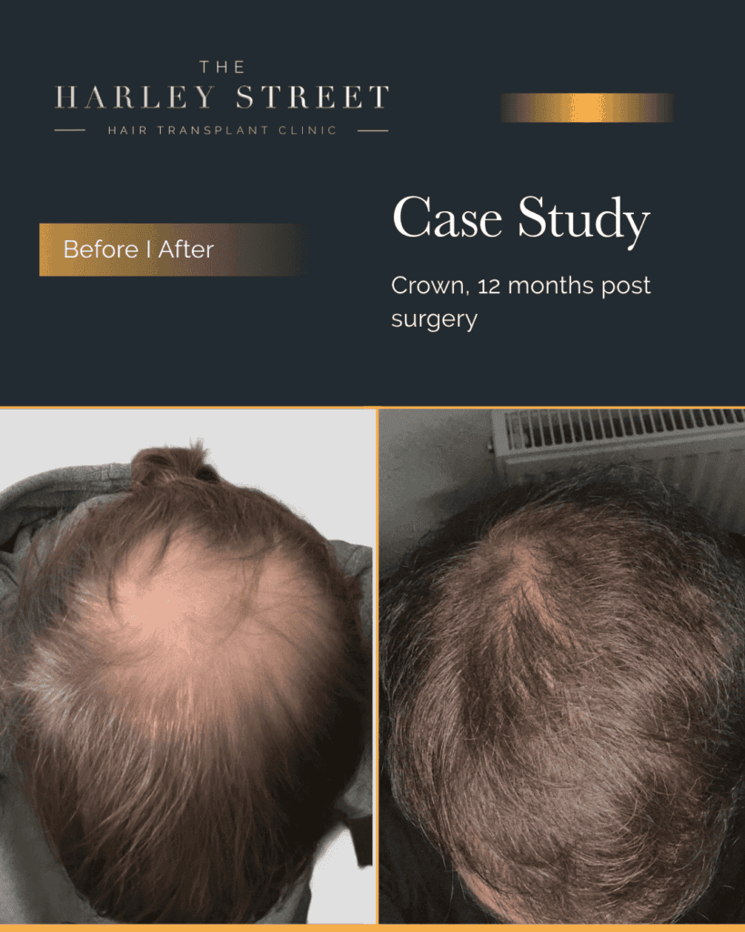 Harley Street HT pt, Wagstaff, crown