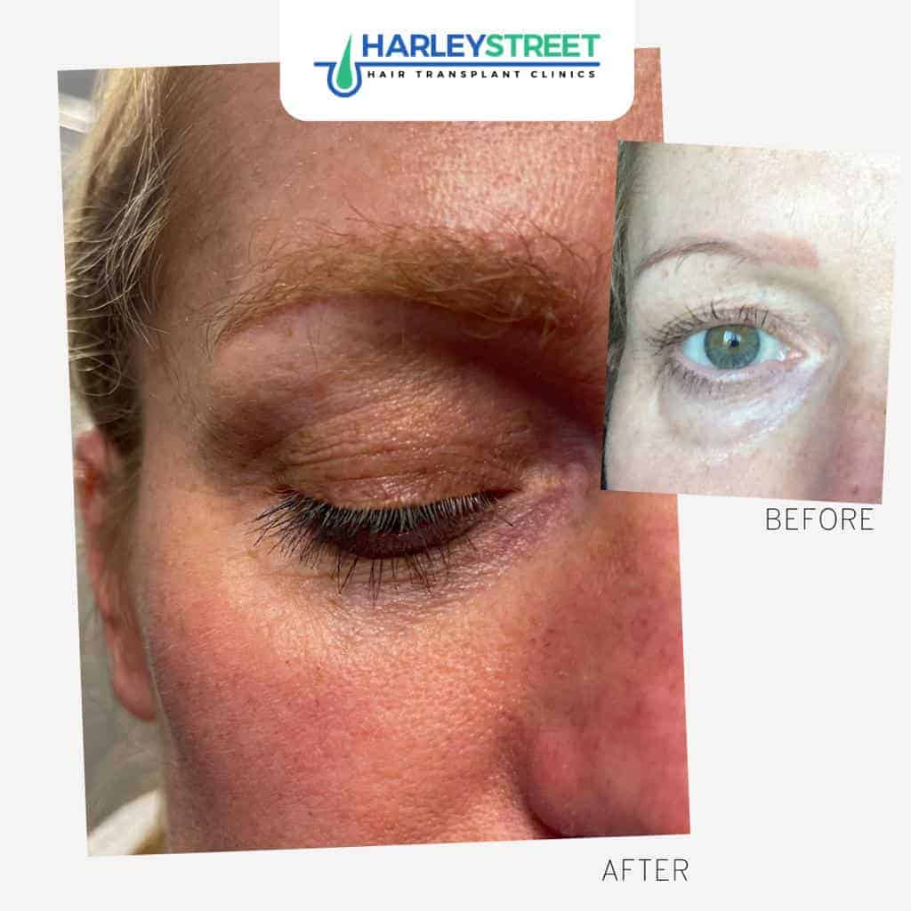 Harley-Street-Hair-Transplant-Clinics-female-patient-eyebrow-transplant-before-and-after