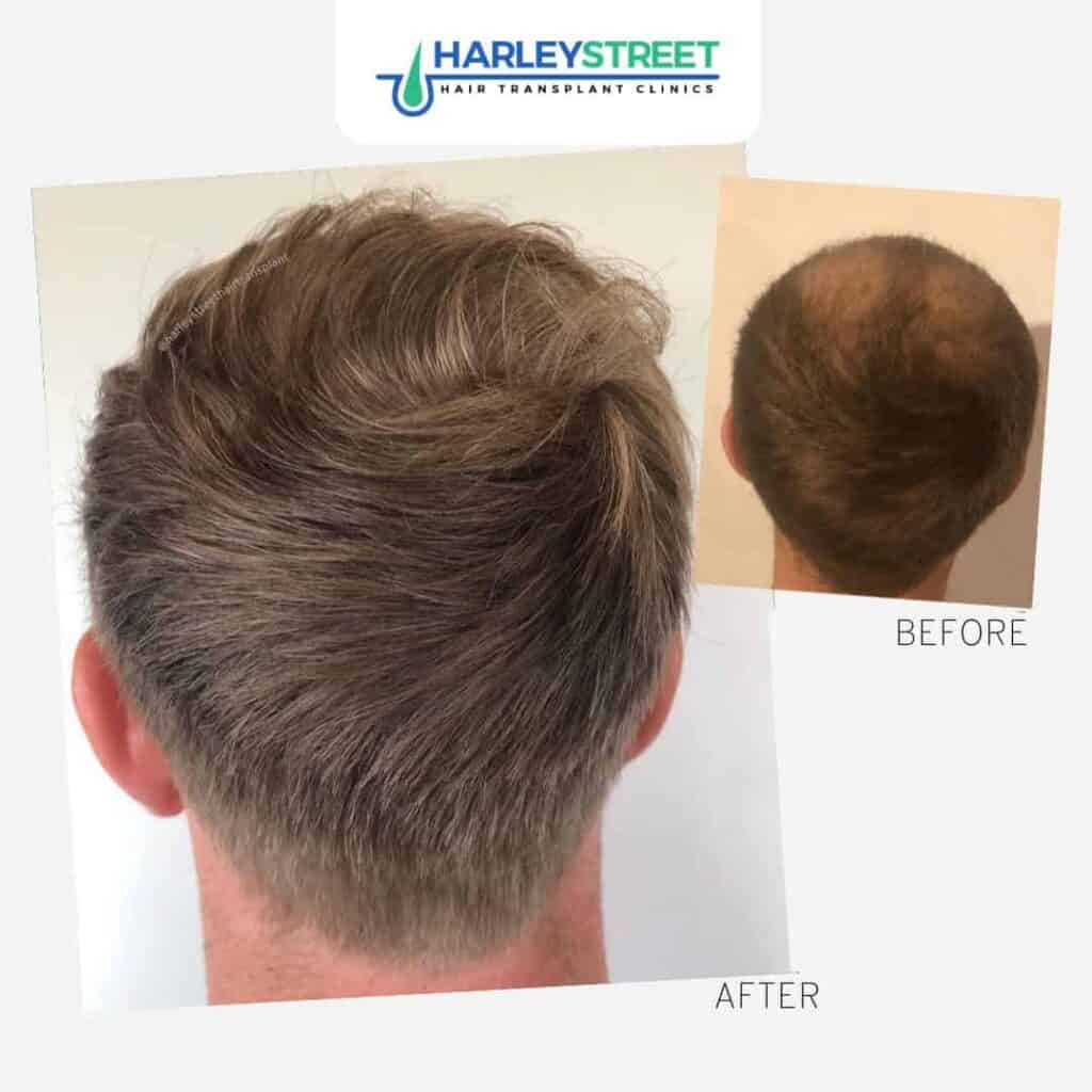 Harley-Street-Hair-Transplant-Clinics-patient-with-crown-recession-before-and-after-procedure