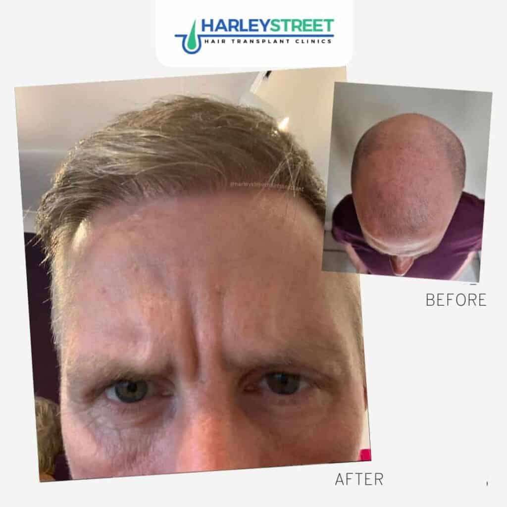 Harley-Street-Hair-Transplant-Clinics-patient-with-top-of-head-hair-loss-before-and-after-1