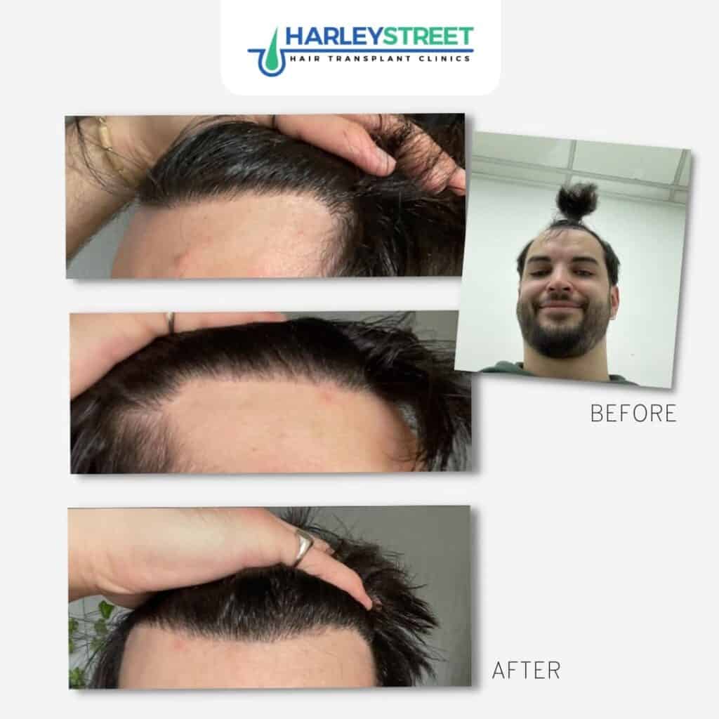 Harley Street Ht Clinics before and after hairline and temples